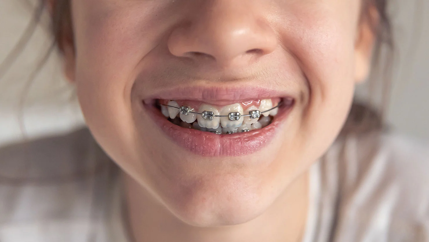 Paciente infantil con aparato dental de brackets metalicos