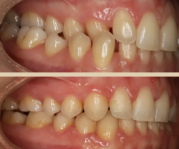 caso clara frontal lateral