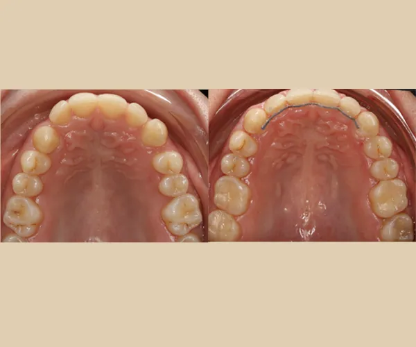 caso clara oclusal