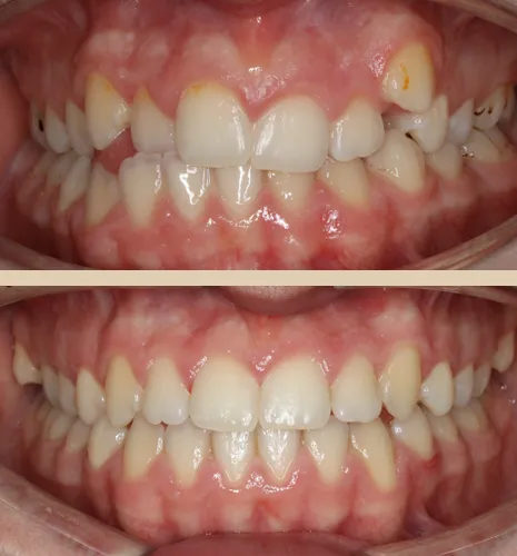 caso iago frontal intraoral