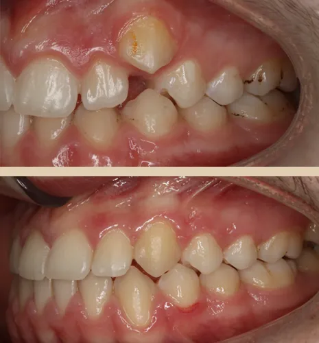caso iago frontal lateral izquierda