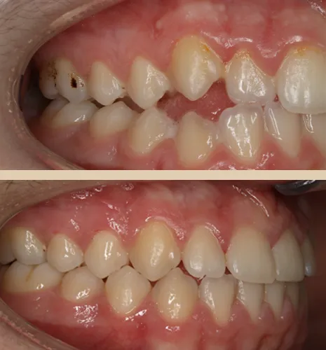 caso iago frontal lateral