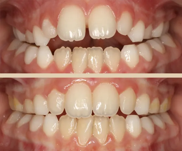 caso sergio l intraoral frontal