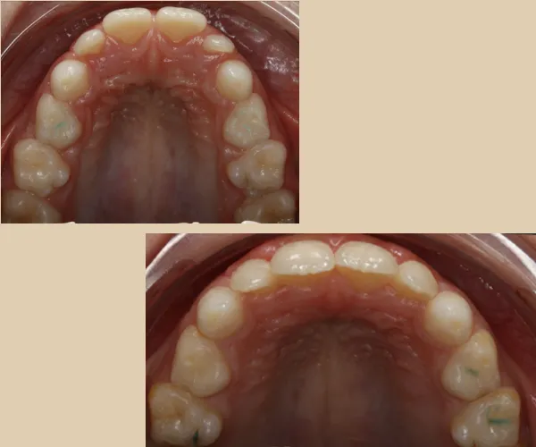 caso sergio l oclusal