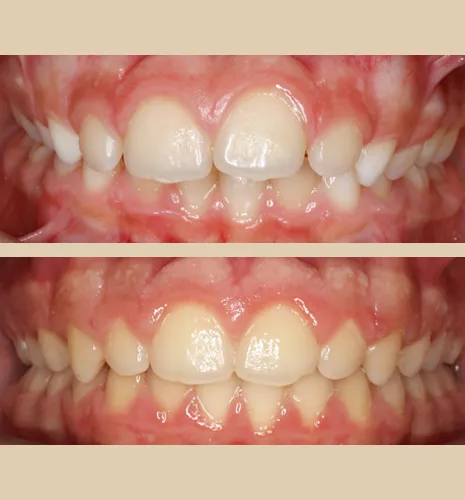caso xose frontal intraoral