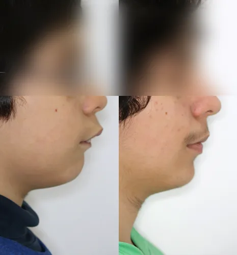 caso xose lateral facial