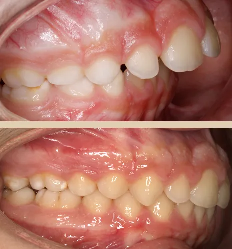 caso xose lateral intraoral